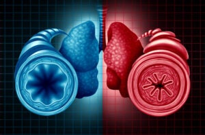 3D diagram of a healthy and unhealthy bronchial tube with a constricted breathing problem caused by respiratory muscle tightening.