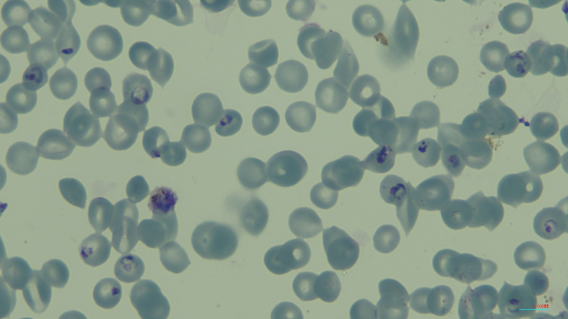 Red blood cells infected with Plasmodium knowlesi parasites (purple). Courtesy: Duraisingh lab.