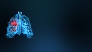 3d rendered illustration of lung cancer