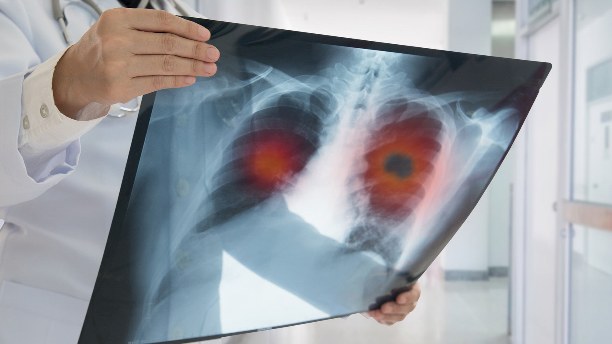 A clinician holds up a lung x-ray. The lungs are marked with red spots.