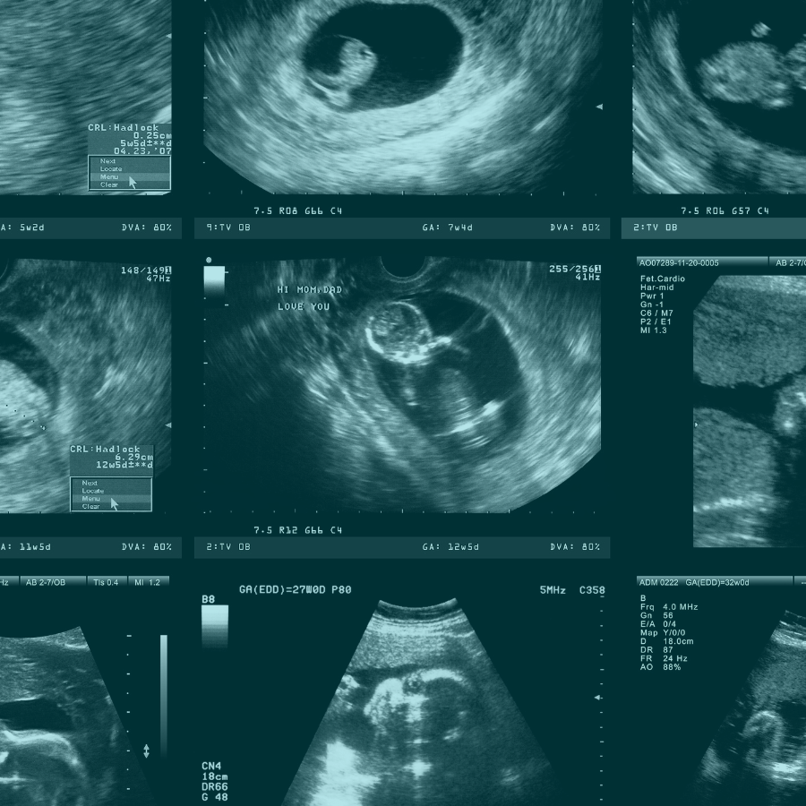 New Publication: Risk of Autism after Prenatal Topiramate, Valproate, or Lamotrigine Exposure