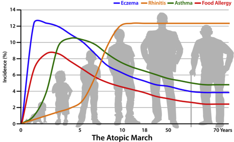 A graphical representation of timing and overlap of the various related immune-mediated allergic diseases eczema (AD) in blue, food allergy in red, asthma in green and rhinitis in orange. This shows the generalized time of onset and duration of each disease.
