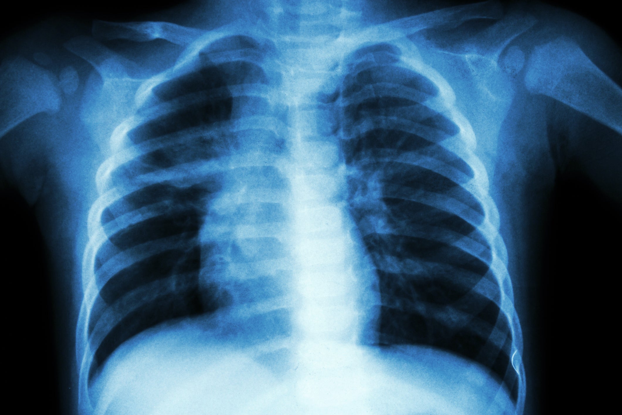 Pulmonary Tuberculosis (Chest X-ray of child : show patchy infiltration at right middle lung)