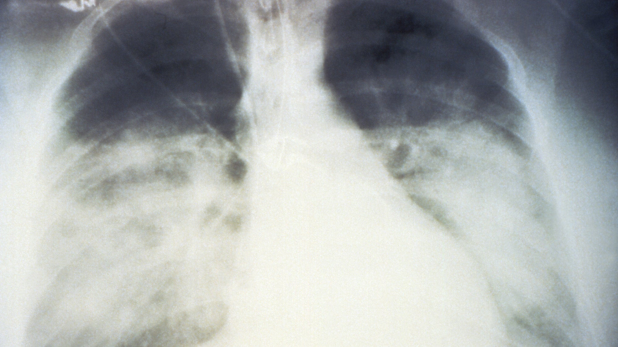 Chest x-ray