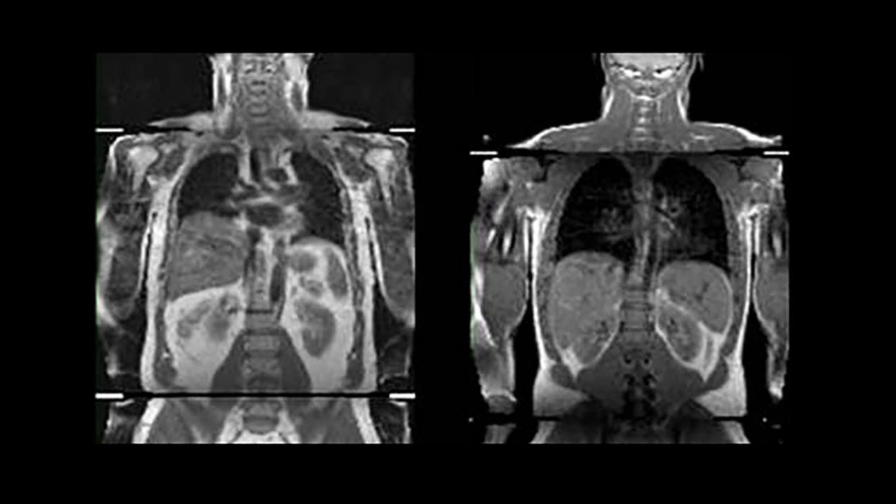 MRI image showing visceral fat