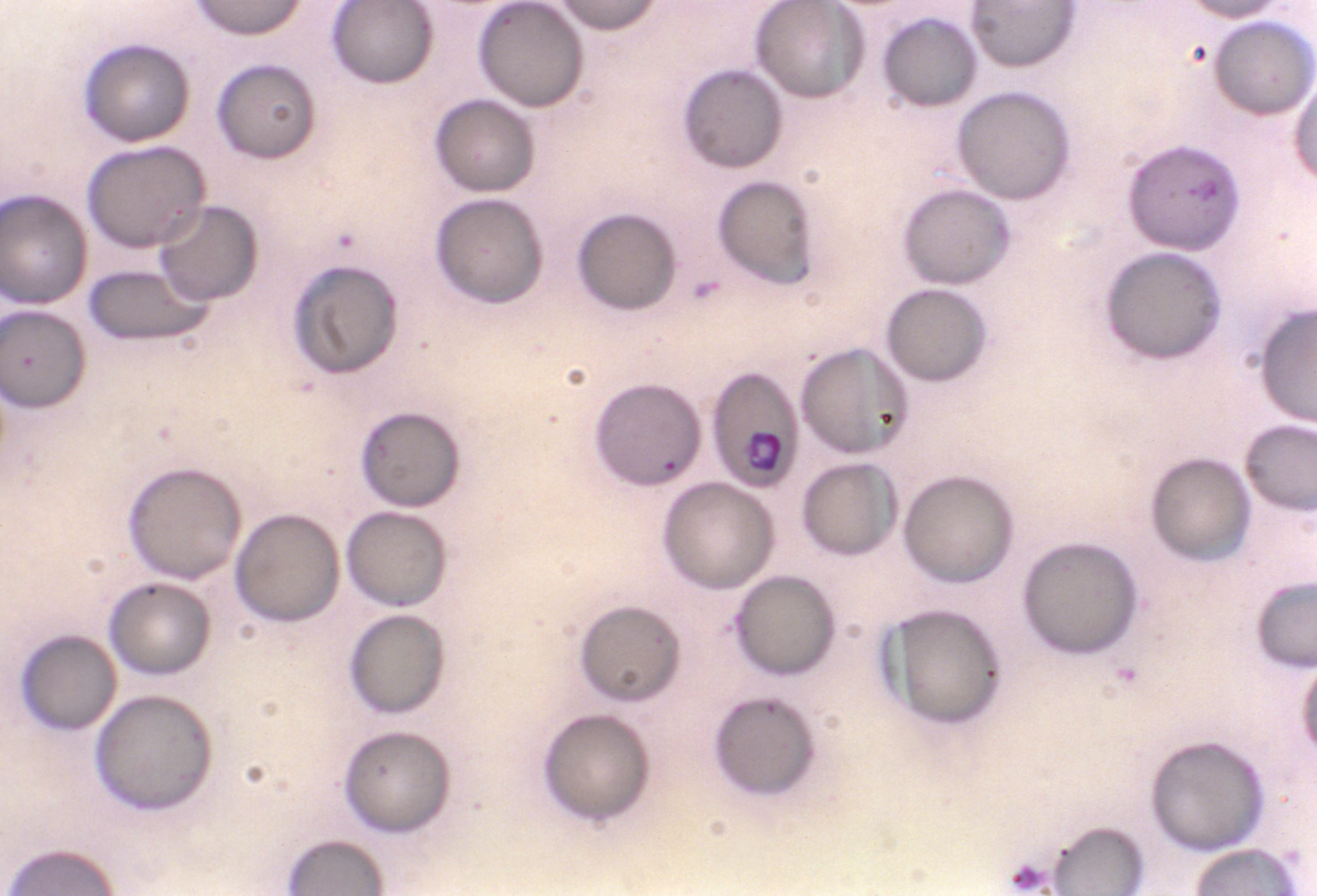 This photomicrograph of a blood smear sample reveals a ring-stage Babesia sp. parasite.